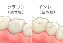 クラウン(詰め物)、インレー(被せ物)