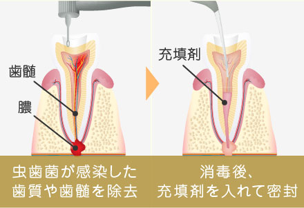 虫歯菌が感染した歯質や歯髄を除去 → 消毒後に充填剤を入れて密封