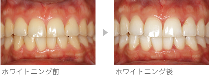 ホワイトニング